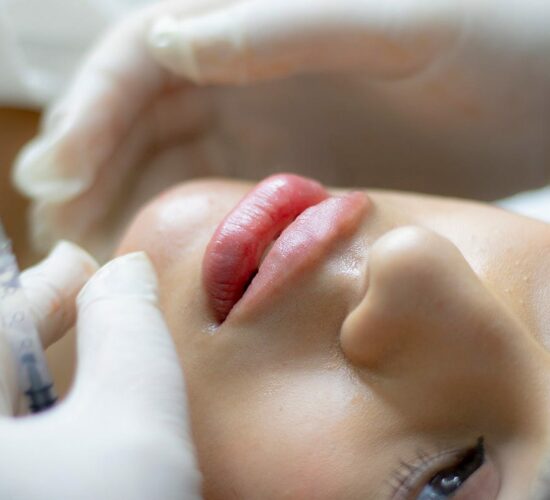 Filler Labbra