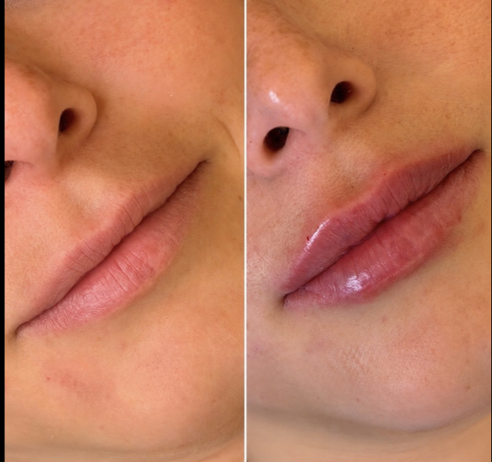 Filler Labbra