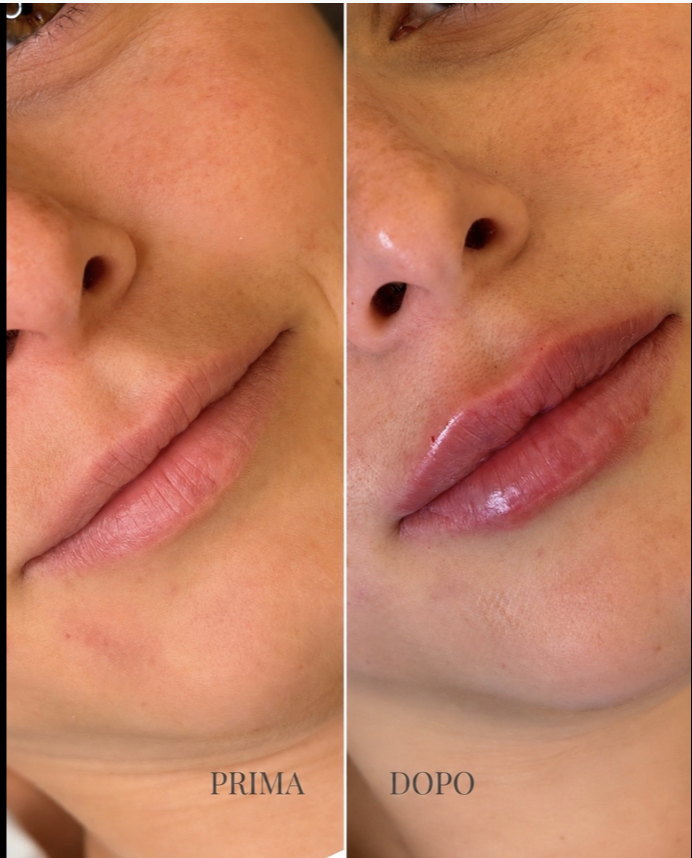 Filler Labbra